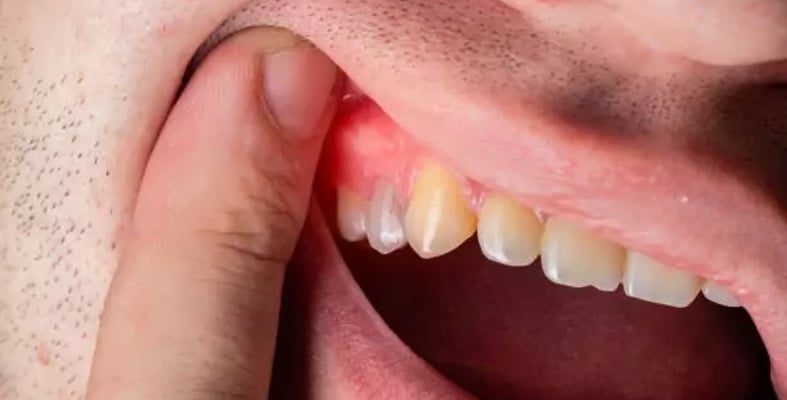 علاج اللثة
