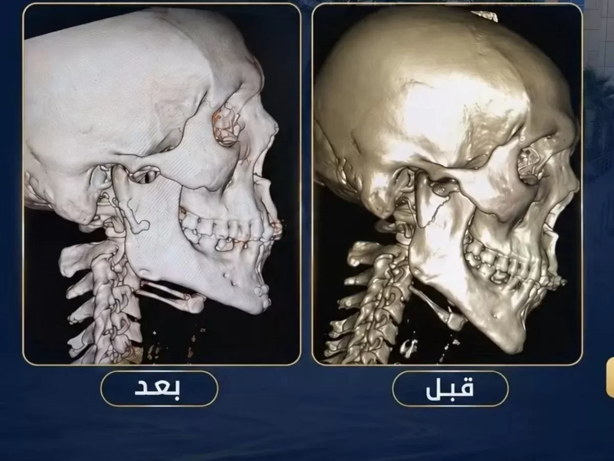 عملية جراحية ناجحة بمستشفى الكرنك بالأقصر