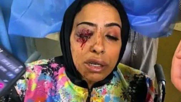 اعتداء وحشي على موظفة بدمياط أثناء تحصيل الأقساط.. فقدت عينها بعد إصابتها في الوجه